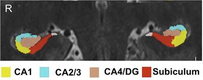 Detection of Hippocampal Subfield Asymmetry at 7T With Automated Segmentation in Epilepsy Patients With Normal Clinical Strength MRIs